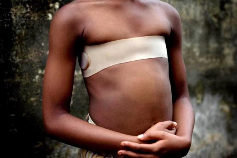 A young girl wearing a band to flatten her breasts.